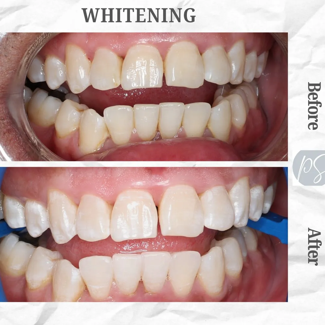 Whitening before and after