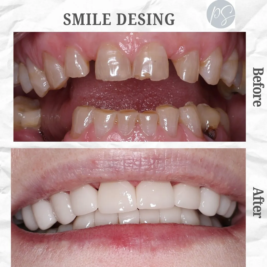 Smile design before and after