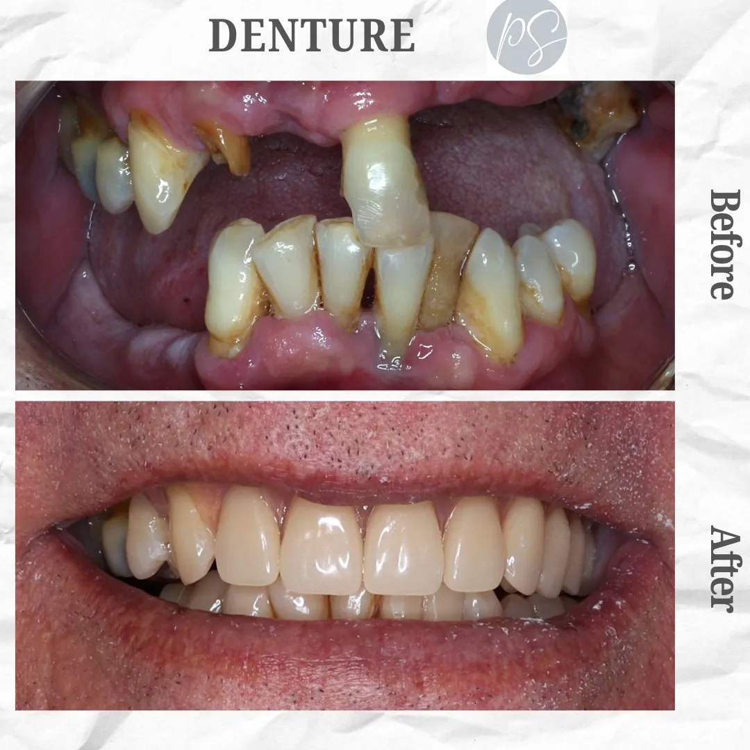 Denture before and after