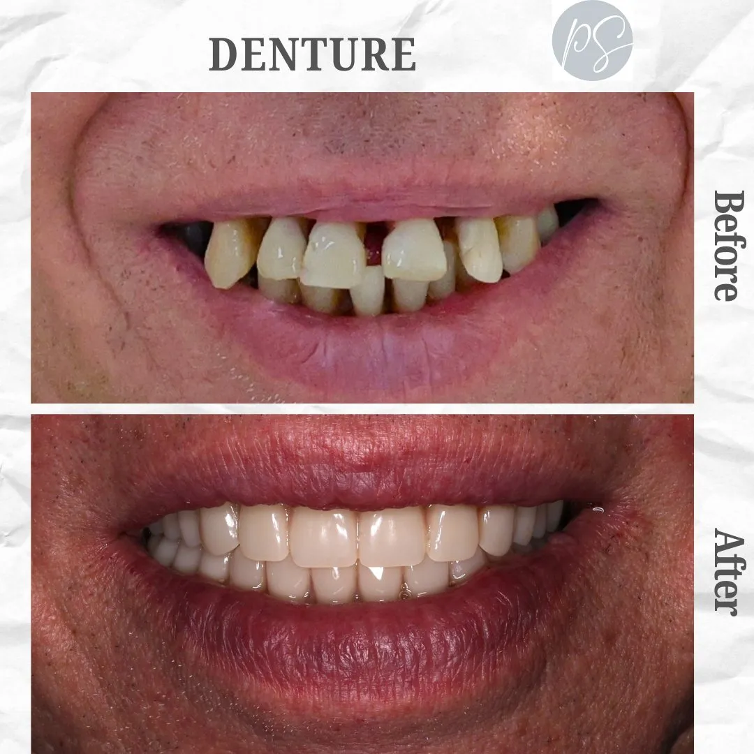 Denture before and after