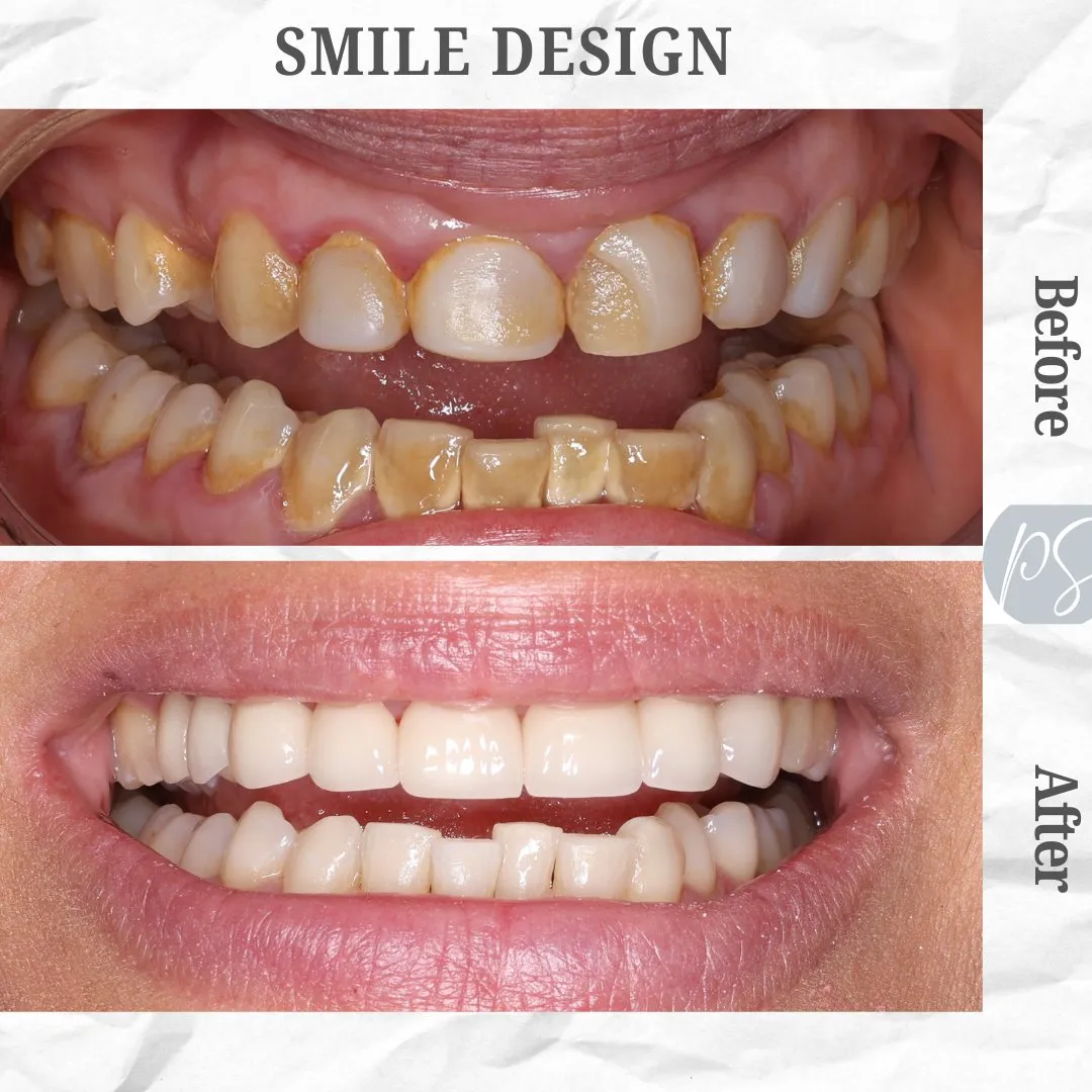 Smile design before and after