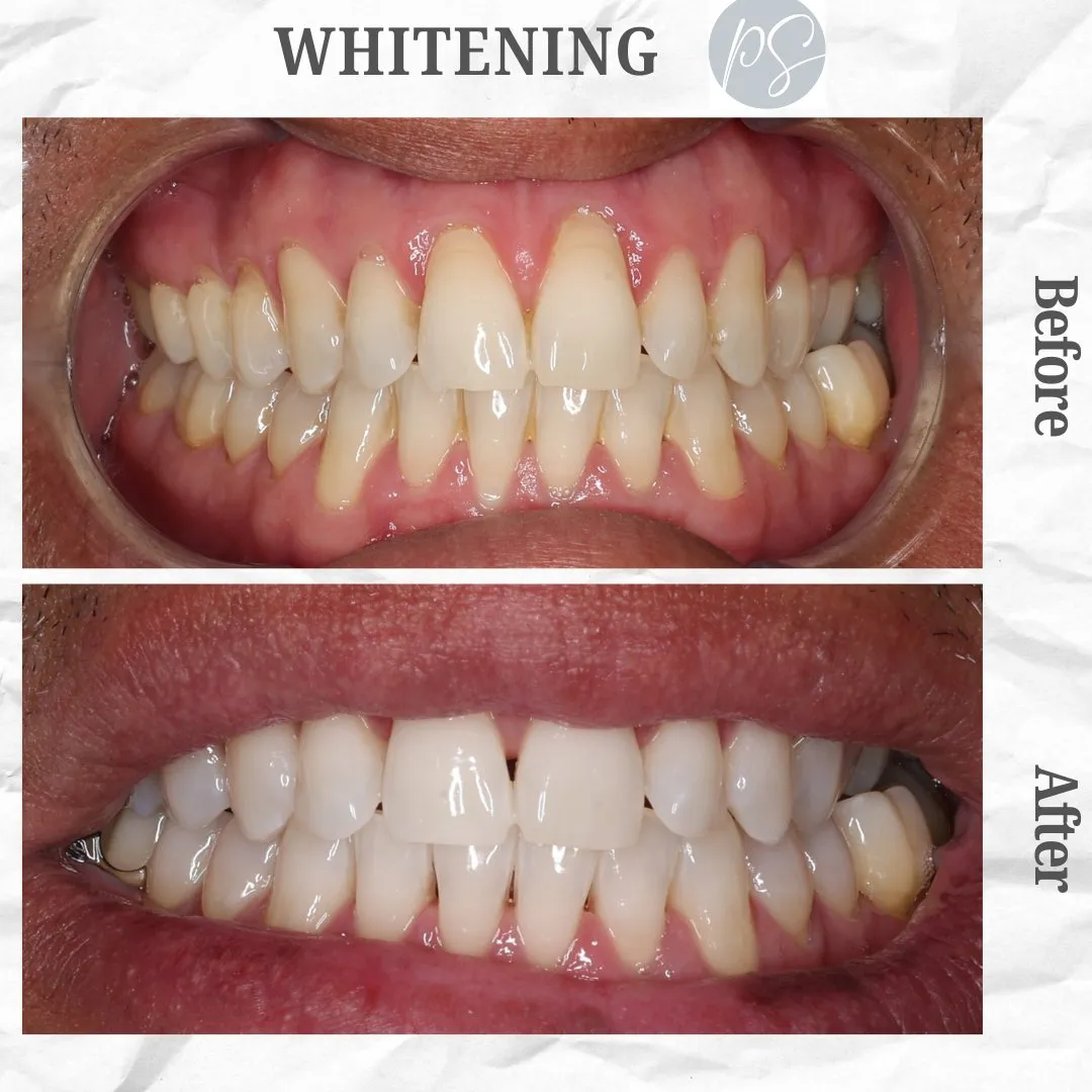 Whitening before and after